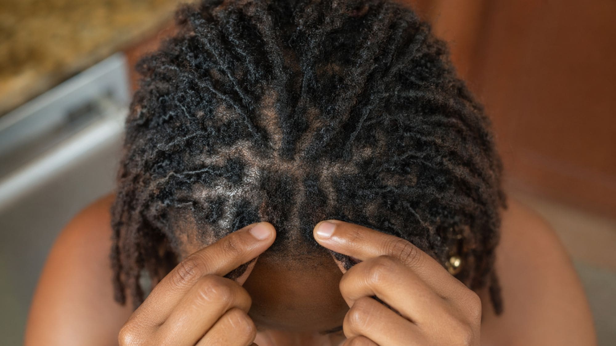 Close-up of thinning loc roots and hairline damage caused by over-retwisting mature locs too frequently